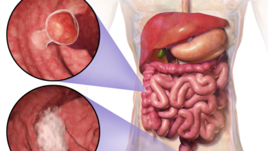 Role of sterol regulatory element binding protein 1a and fatty acid synthase in colorectal carcinoma