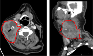 Figure (A&B) A right neck mass at level IIa/III with a cystic component (Red irregular circle), central area of necrosis and calcifications (black arrow). The mass was inseparable from the adjacent sternocleidomastoid muscle- Unified Citation Journals