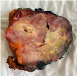 Figure 2: Grossing: A large lateral cervical heterogenous solid tan cut surface mass with cystic spaces and islands of necrosis- Unified Citation Journals