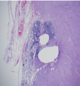 Figure 3: Lateral neck lymph node mass: H&E 4x: Diffuse replacement of lymph node with rime of lymphoid aggregate at the edge- Unified Citation Journals