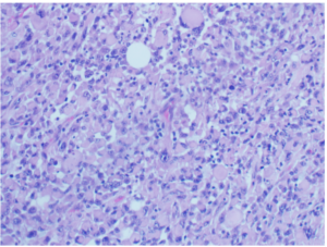 Figure 5: Lateral neck lymph node mass: H&E 20X: Rhabdoid like tumour cells with inflammatory background- Unified Citation Journals