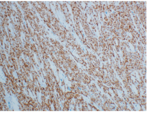 Figure 6: Lateral neck lymph node mass: CK7 stain: positive in tumour cells- Unified Citation Journals