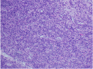 Figure 7: Lateral neck lymph node mass: H&E 20X: Spindle cells neoplastic cells and rare abortive glands in between- Unified Citation Journals