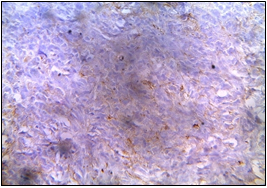 EMA- Negative in tumor cells (Department of Pathology, King George Medical University, Lucknow_ https://ucjournals.com)