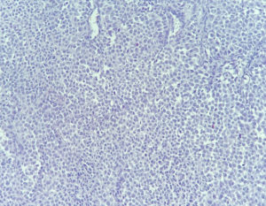 Fig1. Infiltrate of tumor cells. H&E x200