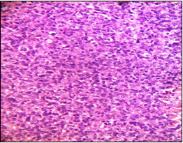 Glioblastoma (Department of Pathology, King George Medical University, Lucknow_ https://ucjournals.com)