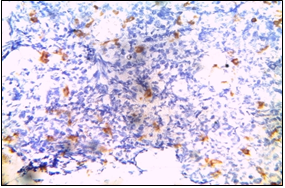 LCA- Negative in tumor cells. (Department of Pathology, King George Medical University, Lucknow_ https://ucjournals.com)