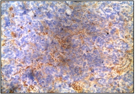 Vimentin- Positive in focal areas (Department of Pathology, King George Medical University, Lucknow_ https://ucjournals.com)