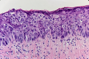 Fig. 10 Paget`s cells often compress the basal keratinocytes that lie between Paget cells and the papillary dermis. Paget cells are located singly or in the form of nests with sparse duct formations.