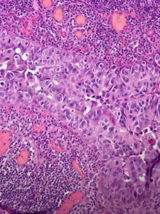 Fig. 11 Dermal pseudo-invasion of Paget's cells. It is noteworthy that this is not a true dermal invasion, but only pseudo-immersion into the dermis along the adnexal ducts.