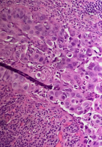 Fig. 12 Dermal pseudo-invasion of Paget's cells. Same case as Fig. 11, different field of view.