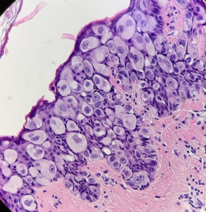 Fig. 19 Hyperplastic Toker's cells in the epidermis. Pronounced pleomorphism of cells and nuclei, prominent nucleoli, figures of mitosis, but less in comparison with Paget cells