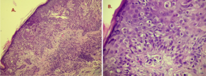 Fig. 21 A-B. Melanoma of the nipple. Melanocytes vary greatly in size as well as nuclear atypia. Note the lack of melanin depositions.