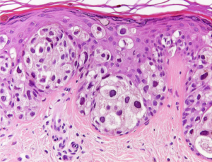 Fig. 25. BAP1-oma with Pagetoid cells. Pagetoid cells infiltrate all layers of the epidermis. Prominent pleo- and polymorphism. [37]