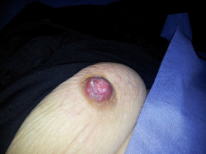 Fig. 7 Gross view of Paget's breast disease. There are slight ulcerative lesion of the nipple and the presence of pale overlays.