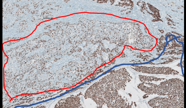 Immunohistochemistry stains: Positivity for TTF1 and PAX8 (10x) in the solid, poorly differentiated part (blue irregular circle) and squamous area (red irregular circle