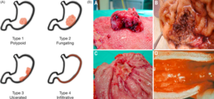 Figure 4 Growth patterns and macroscopic appearance of advanced gastric cancer according to the Bormann classification [13]