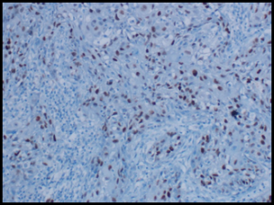 (G): Immunohistochemistry stain: P53 (20x) overexpression in the squamous components. 