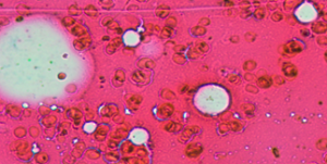 Figure 4: Pearls stain with depleted iron deposits suggestive of iron deficiency anemia