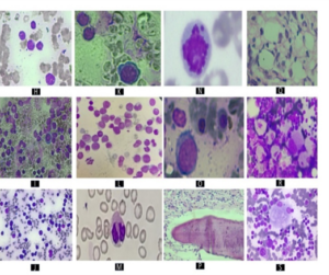 Figure 3: (H) Small cells in ALL L1 (I) Large cells with abundant basophilic cytoplasm in ALL L2 (J, K)- Heterogenous population of small and large cells in NHL (L)- Metamyelocytes, myeloblasts and promonocytes in JMML (M, N)- Pelger-Huet neutrophil and dyserythropoiesis in MDS (O,P,Q)- Leukoerythroblastic picture, Inter and intra trabecular fibrosis with no megakaryocyte, Dilated sinusoids with absent megakaryocyte within it – Overt stage PMF (R,S)- Gaucher cells with “wrinkled tissue paper appearance” in Gauchers disease