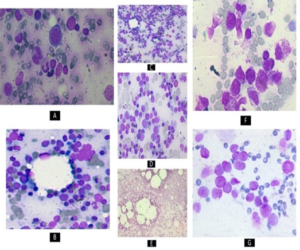 Figure 2: (A) - Megaloblasts in megaloblastic anemia (B)-Micronormoblastic erythropoiesis in iron deficiency anemia (C, D)- Both megaloblasts and micronormoblastic erythropoiesis in combined nutritional deficiency (E)-Sparsely cellular and filled with fat spaces in aplastic anemia (F)- Myeloblasts in APL(G)- Promyelocytes with Auers rods and faggot cells in APL